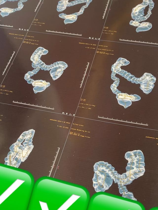 Publicação com imagens do intestino grosso